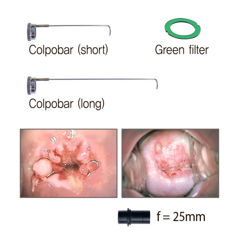 Video Colposcope